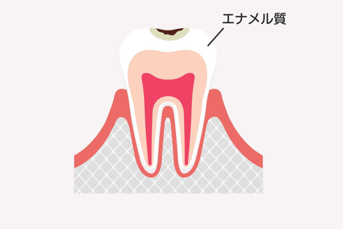C1｜エナメル質のむし歯