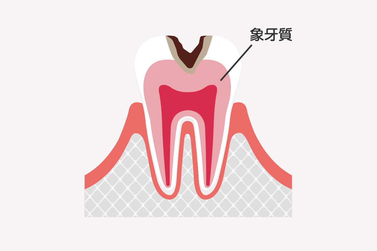 C2｜象牙質のむし歯