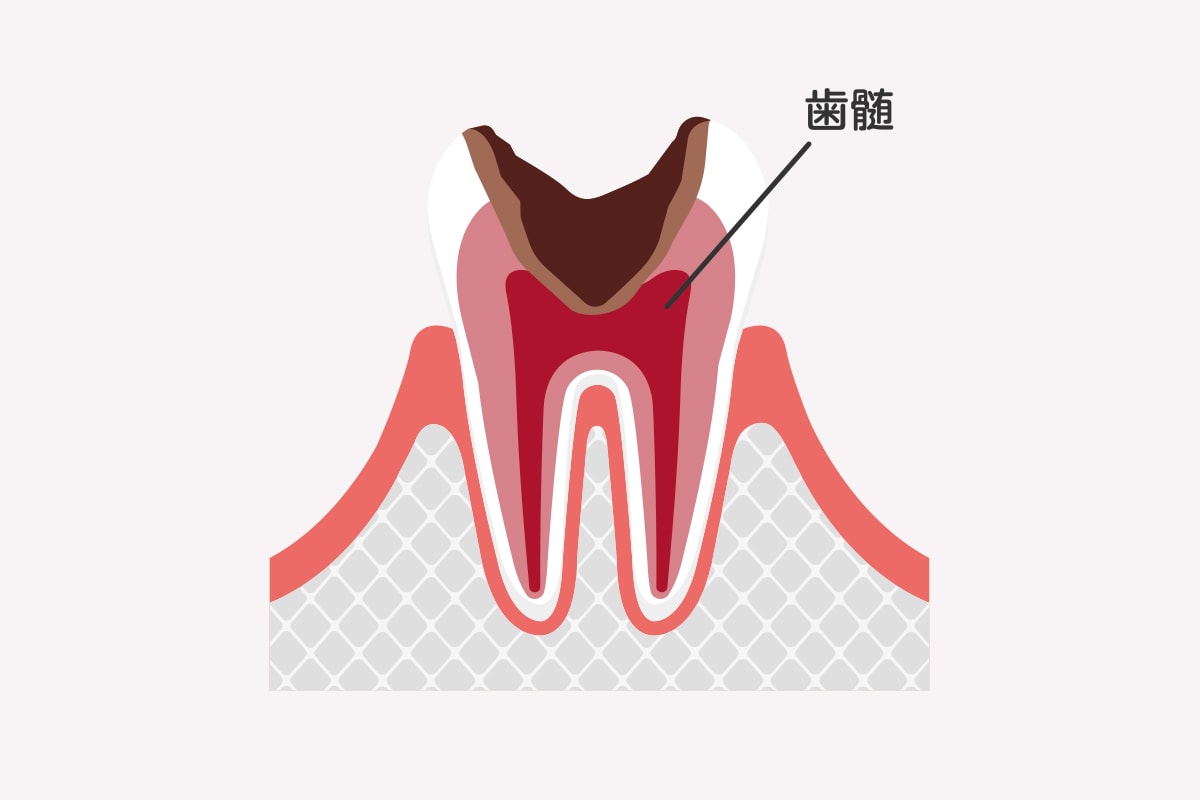 C3｜神経まで達したむし歯