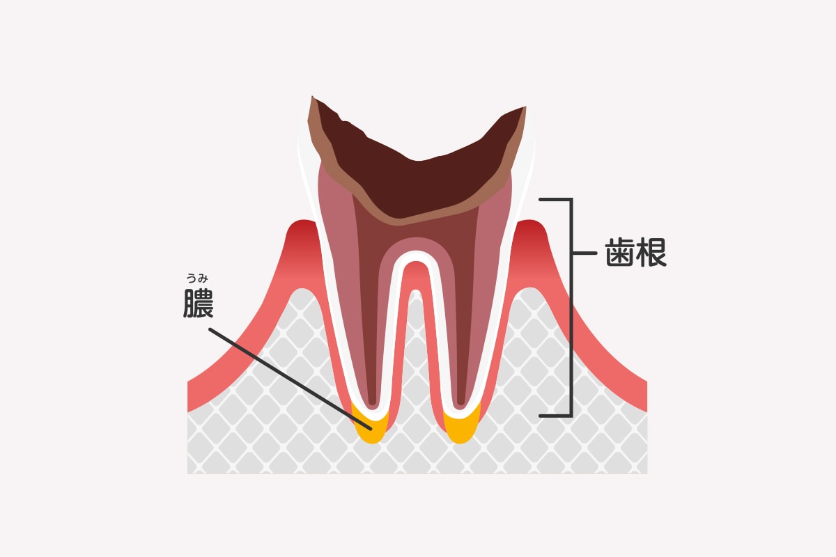 C4｜歯根まで達したむし歯